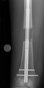 Externer mit dem Knochen verschraubter Beinexpander